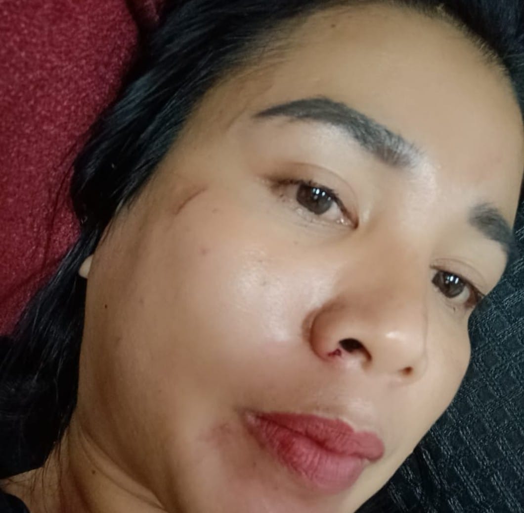 Bantah Aniaya Rekannya Sesama Honorer di DPRD Tanggamus di Jakarta, RS Akan Lapor Balik